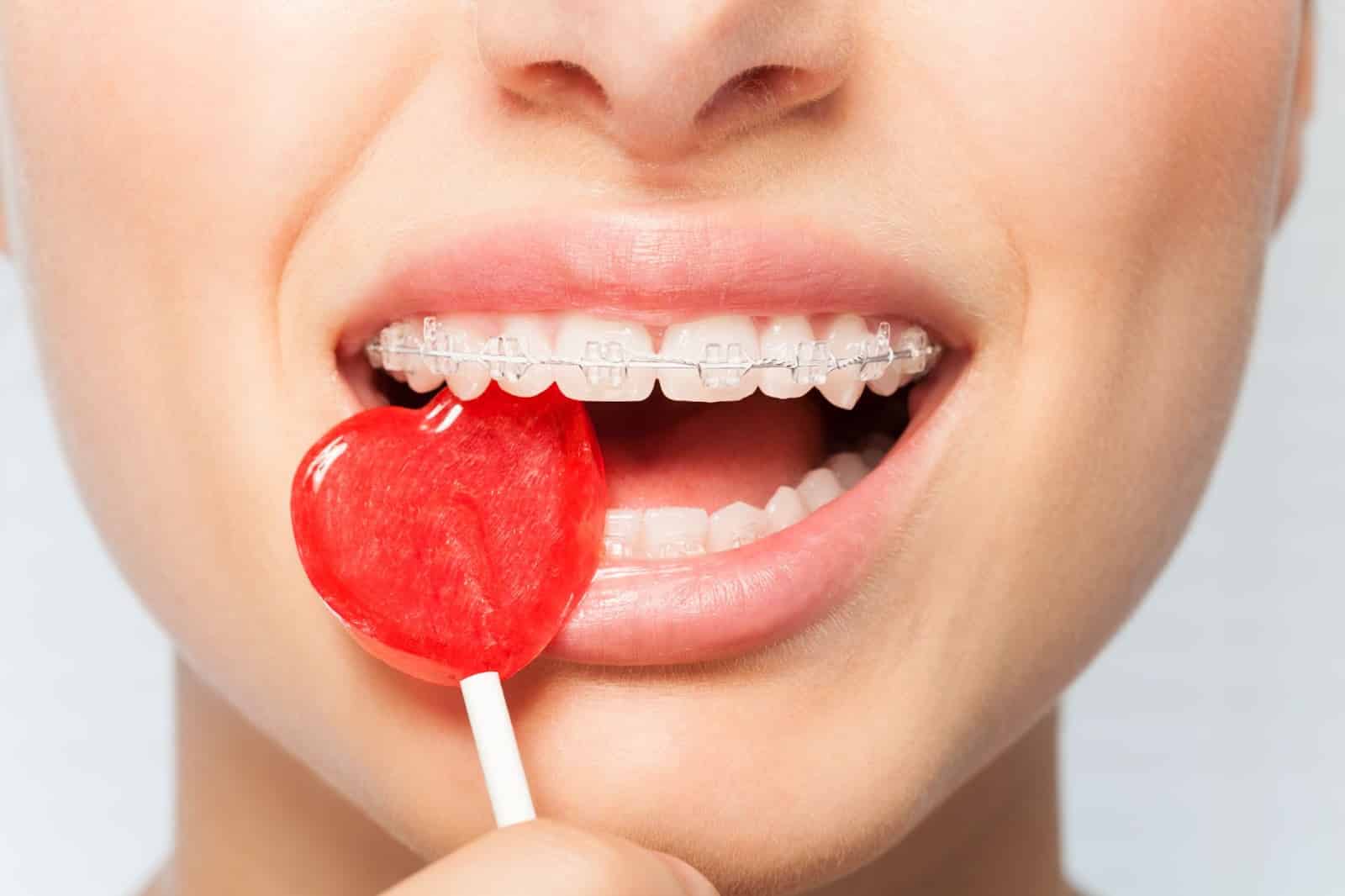 5 Foods to Avoid with Braces